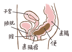 直腸瘤の図